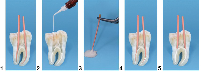 Пломбирование каналов методом одного штифта